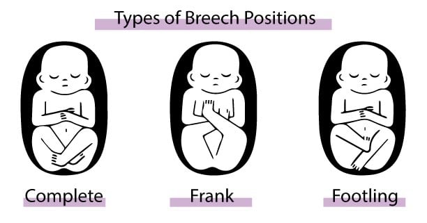 Types of breech positions