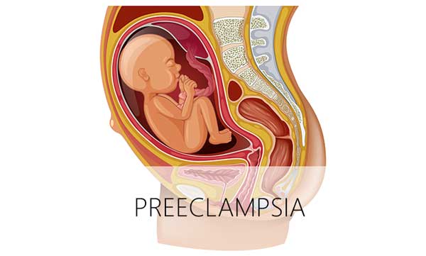 Preeclampsia: Symptoms, Risks, Treatment and Prevention