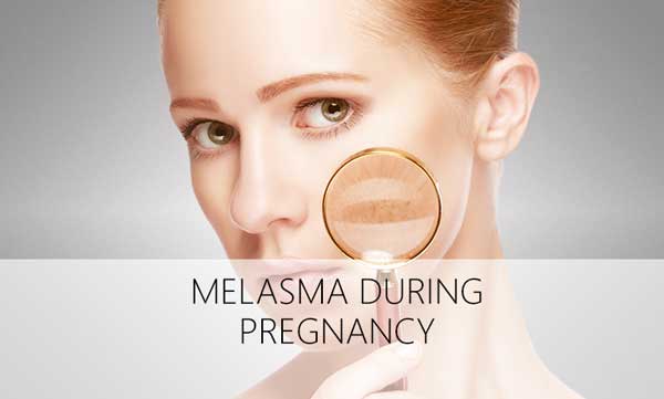 Melasma during Pregnancy – Causes and Treatment