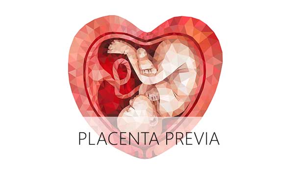 Placenta Previa: Symptoms, Causes and Treatment